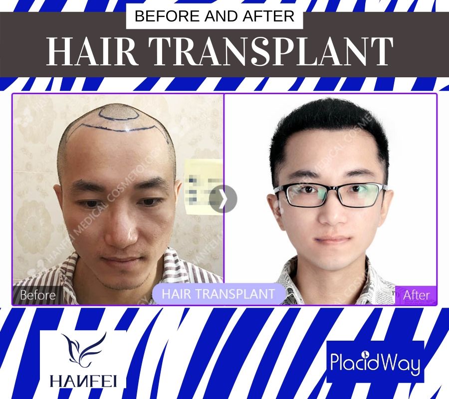 Hair Transplant Before and After, Guangzhou, China